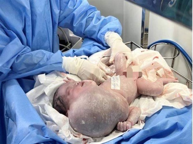 TP.HCM: Tách thành công khối bướu khủng cho bé sơ sinh 3 ngày tuổi